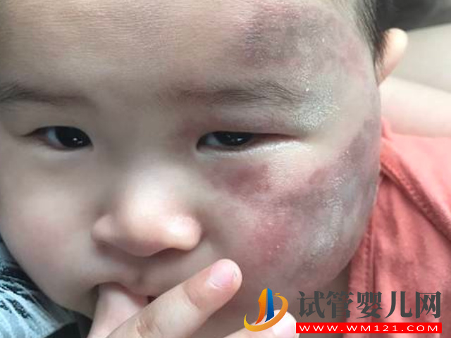 兒童不同位置胎記圖解大全，是福是禍點看看了才知道(圖2)