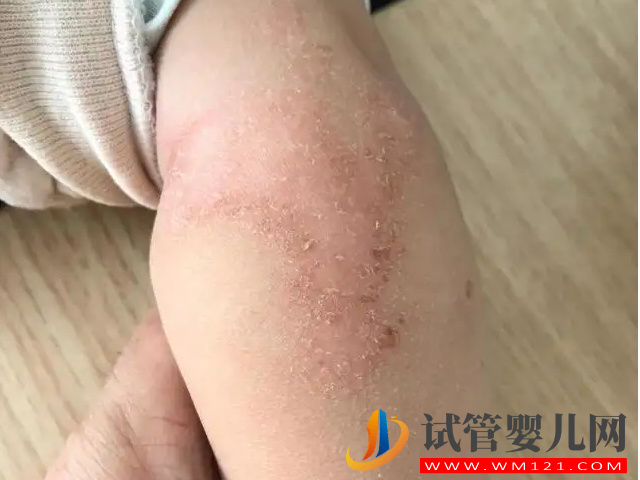 5種常見典型濕疹類型圖片分享，不同類型“防與治”都不一樣(圖1)