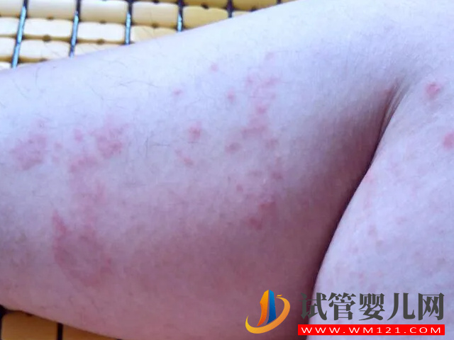 5種常見典型濕疹類型圖片分享，不同類型“防與治”都不一樣(圖2)