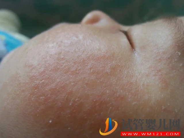 5種常見典型濕疹類型圖片分享，不同類型“防與治”都不一樣(圖3)