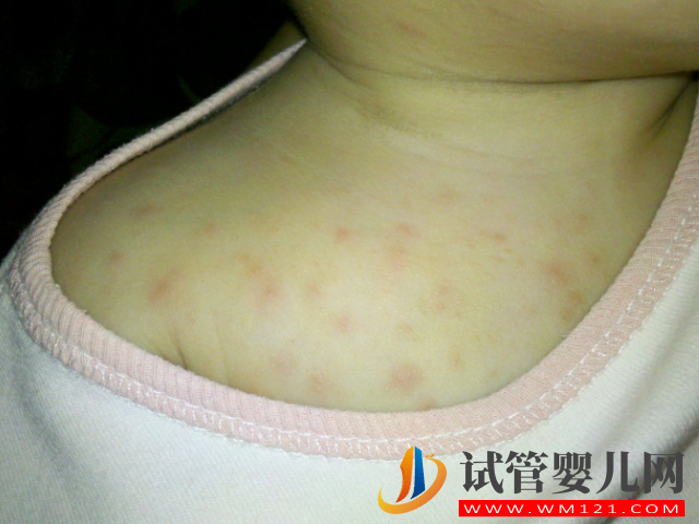 新生兒臉上冒濕疹不用慌，家庭護理小妙招輕松處理(圖1)