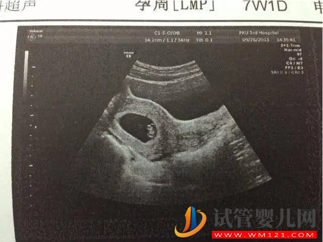 b超監測有卵黃囊基本是宮內妊娠，不管出現早晚都穩了(圖2)