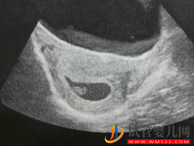 b超監測有卵黃囊基本是宮內妊娠，不管出現早晚都穩了(圖3)
