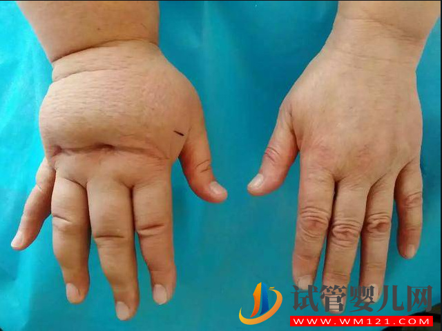 孕期浮腫已暗示生男生女，浮腫程度和時間天差地別(圖1)