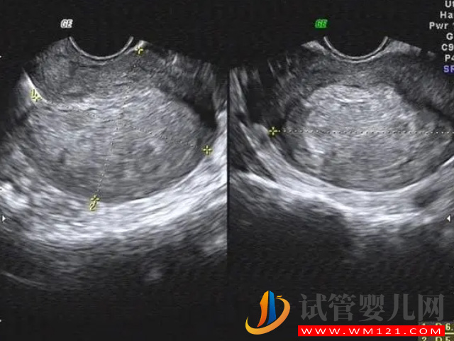 子宮內膜薄做試管攻略分享，選對適合試管技術為首要條件(圖3)