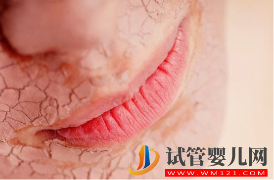 瀘州孕期皮膚干燥應(yīng)該怎么辦？(圖1)