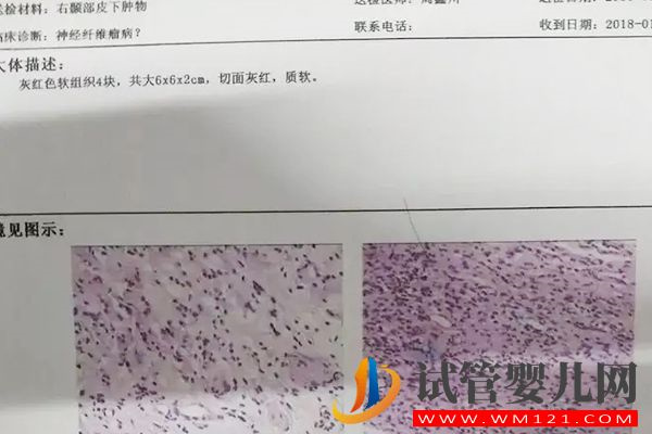 3代試管篩查神經(jīng)纖維瘤方法詳解：三個步驟可提高準確率(圖3)