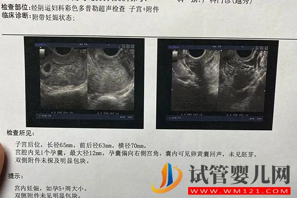 自貢檢查卵泡做b超還是陰超視情況而定，但這3點區別要知曉(圖3)