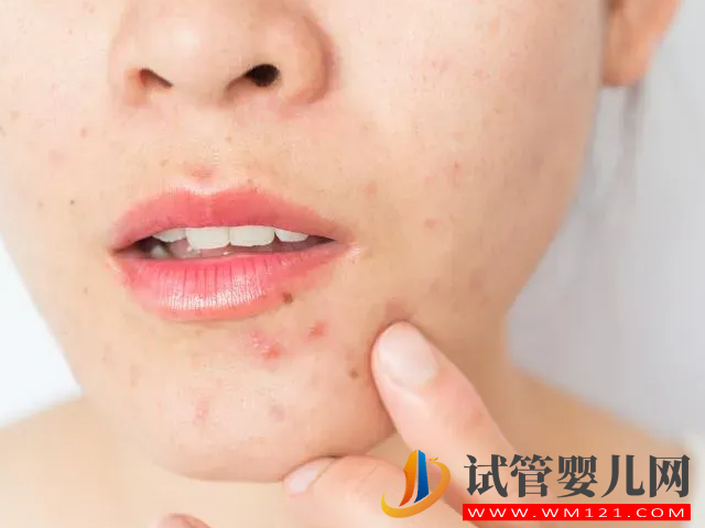 女性多囊長痘和普通長痘有區別，外在表現和癥狀都不一樣(圖3)
