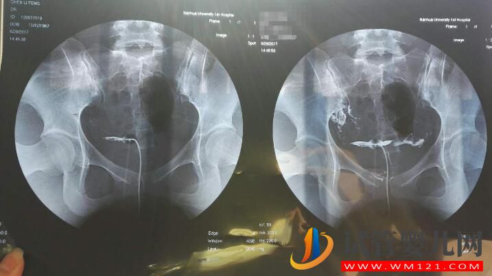 試管嬰兒前做輸卵管造影的意義是什么？所有做試管都有必要做嗎(圖2)