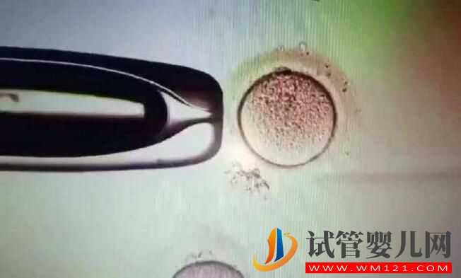 子宮腺肌癥能做試管嬰兒嗎？應該如何備孕(圖4)