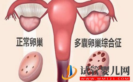 多囊卵巢綜合征六個表現(xiàn)(圖1)