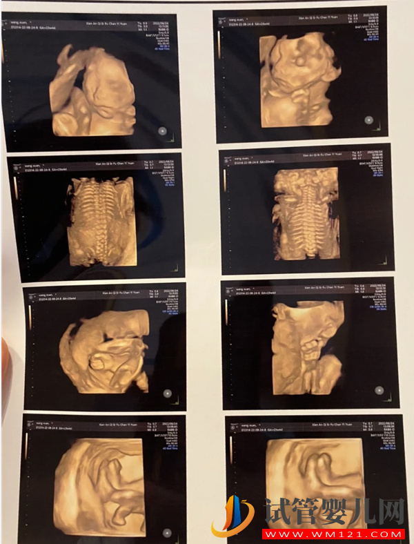 孕期做四維彩超讓寶寶露臉的好方法有4種，找到技巧很關鍵！(圖2)