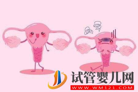 子宮內(nèi)膜異位到底是什么,有哪些癥狀_又該如何預(yù)防(圖2)