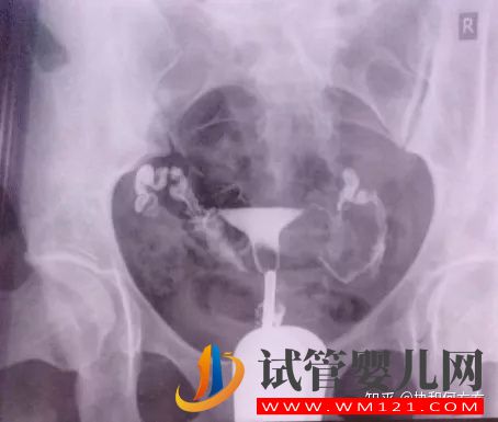 輸卵管造影片的解讀,你理解對了嗎(圖3)