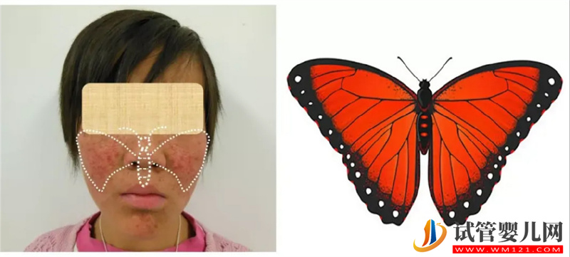 罕見！“蝴蝶結癥”母女遠赴2600公里求醫(圖1)