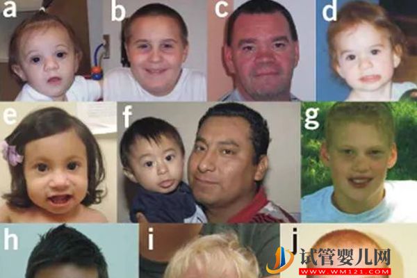 染色體1q21·1片段重復綜合征詳解，該病超五成遺傳自母親(圖2)