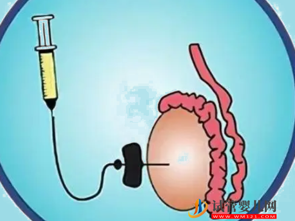 睪丸穿刺能否降低dna碎片率篩選精子質量(圖1)