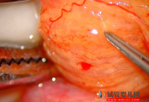 顯微取精技術(shù)和睪丸穿刺有差異，相關(guān)區(qū)別不只是費(fèi)用！(圖4)