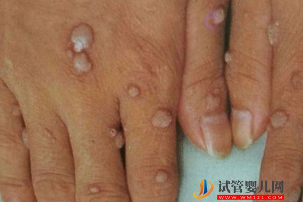 HPV男女自查10個方法匯總，有紅色丘疹等癥狀要提高警惕！(圖2)