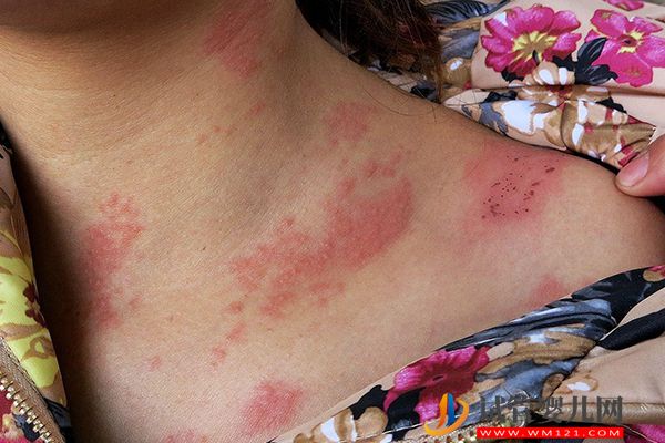 HPV男女自查10個方法匯總，有紅色丘疹等癥狀要提高警惕！(圖3)