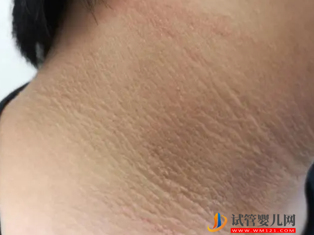 多囊卵巢癥狀自查方法分享，有這5個表現(xiàn)要及早就診(圖2)