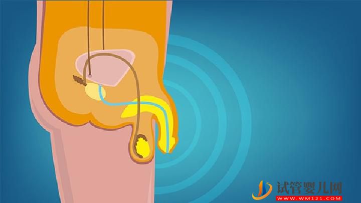 哪些習(xí)慣誘發(fā)男性不育？治療男性不育從這點(diǎn)開始(圖2)