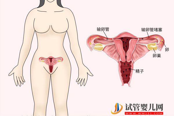 輸卵管阻塞是導(dǎo)致不孕的一大元兇，當(dāng)出現(xiàn)這3個癥狀時需要注意了!(圖1)