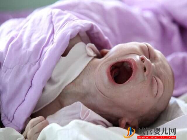 19號染色體片段缺失的小孩行為會有哪些表現(xiàn)？(圖1)