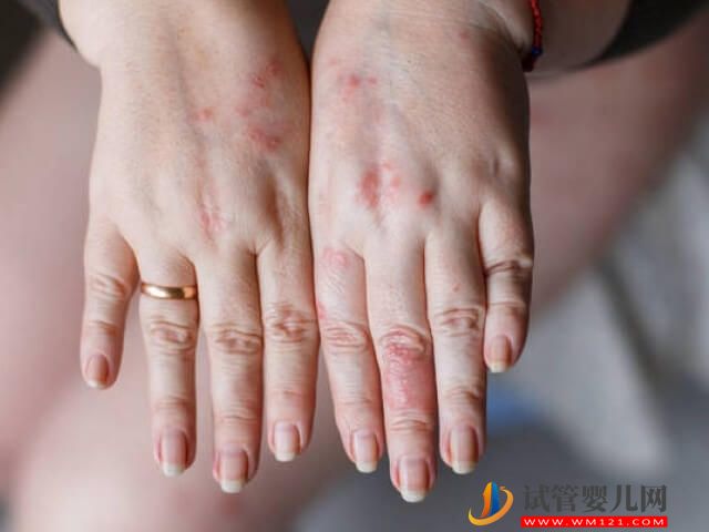 無創顯示胎兒22號染色體三體是什么意思？(圖2)