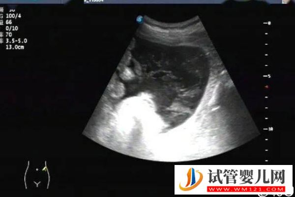 取卵后醫(yī)生會在第一次來月經(jīng)移植還是第二次移，60s弄清(圖2)