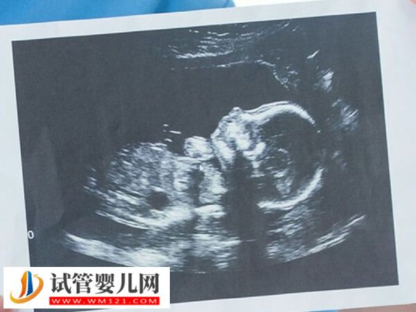 根據(jù)最新數(shù)據(jù)顯示,位于石家莊的河北醫(yī)科大學(xué)第三醫(yī)院、河北省人民醫(yī)院、河北省婦幼保健院等醫(yī)院都是有開(kāi)展試管嬰兒這項(xiàng)輔助生殖助孕技術(shù)。但不管是在哪家醫(yī)院做試管嬰兒,其費(fèi)用主要就包括了術(shù)前檢查費(fèi)用、促排卵治療費(fèi)用、手術(shù)費(fèi)用以及移植后的保胎和驗(yàn)孕費(fèi)用這四項(xiàng),總開(kāi)支在2.5萬(wàn)-6.5萬(wàn)元左右,當(dāng)然具體費(fèi)用還會(huì)根據(jù)個(gè)人情況而有所差異。 石家莊做試管嬰兒多少錢(qián)一次 試管嬰兒被廣泛應(yīng)用于不孕不育夫婦中。作為河(圖1) 上海集愛(ài)醫(yī)院助孕步驟分享,掛號(hào)到驗(yàn)孕流程匯總(圖1)